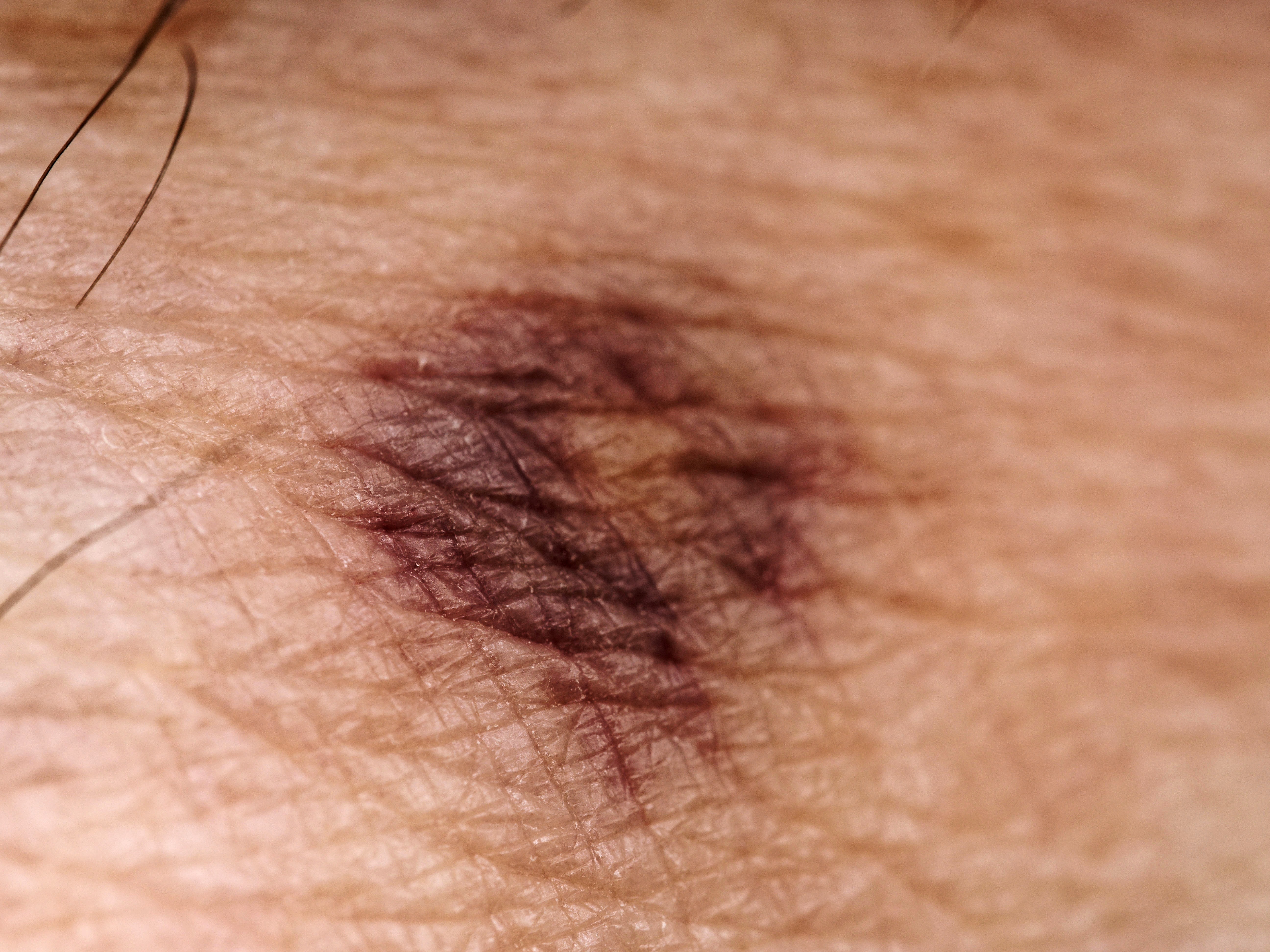 Photo Bruise-1.jpeg.  Click to redisplay small version of image. https://lemis.nyc3.digitaloceanspaces.com/grog/Photos/20251026/big/Bruise-1.jpeg
