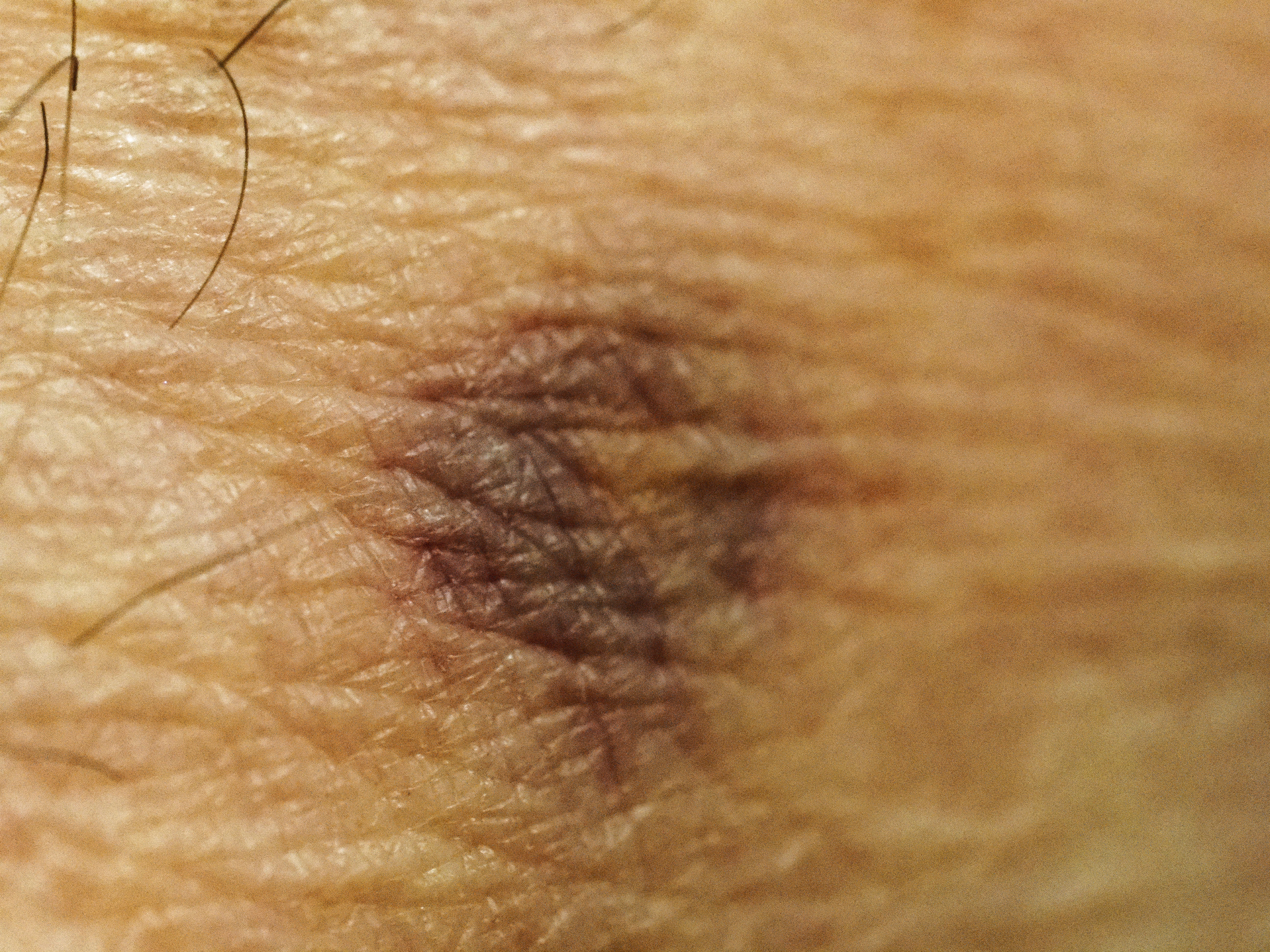 Photo Bruise-2.jpeg.  Click to redisplay small version of image. https://lemis.nyc3.digitaloceanspaces.com/grog/Photos/20251026/big/Bruise-2.jpeg