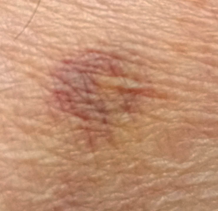Photo Bruise-3-orig.jpeg.  Click to redisplay image at screen width. https://lemis.nyc3.digitaloceanspaces.com/grog/Photos/20251026/big/Bruise-3-orig.jpeg