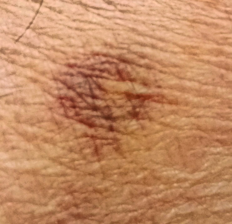 Photo Bruise-3.jpeg.  Click to redisplay image at screen width. https://lemis.nyc3.digitaloceanspaces.com/grog/Photos/20251026/big/Bruise-3.jpeg