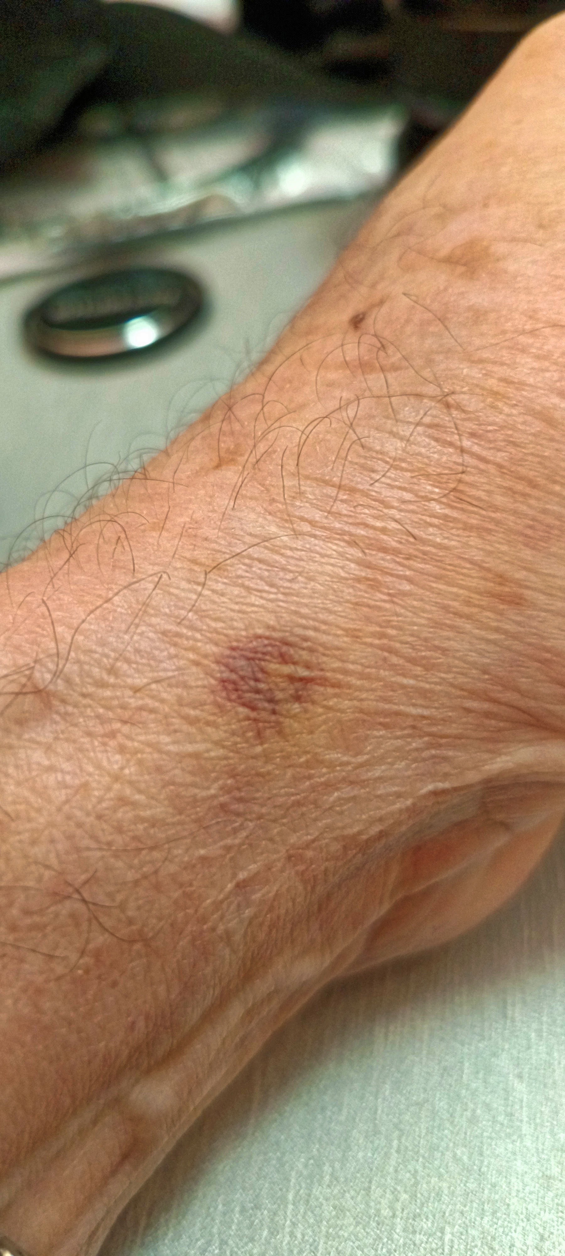 Photo Bruise-4.jpeg.  Click to redisplay small version of image. https://lemis.nyc3.digitaloceanspaces.com/grog/Photos/20251026/big/Bruise-4.jpeg