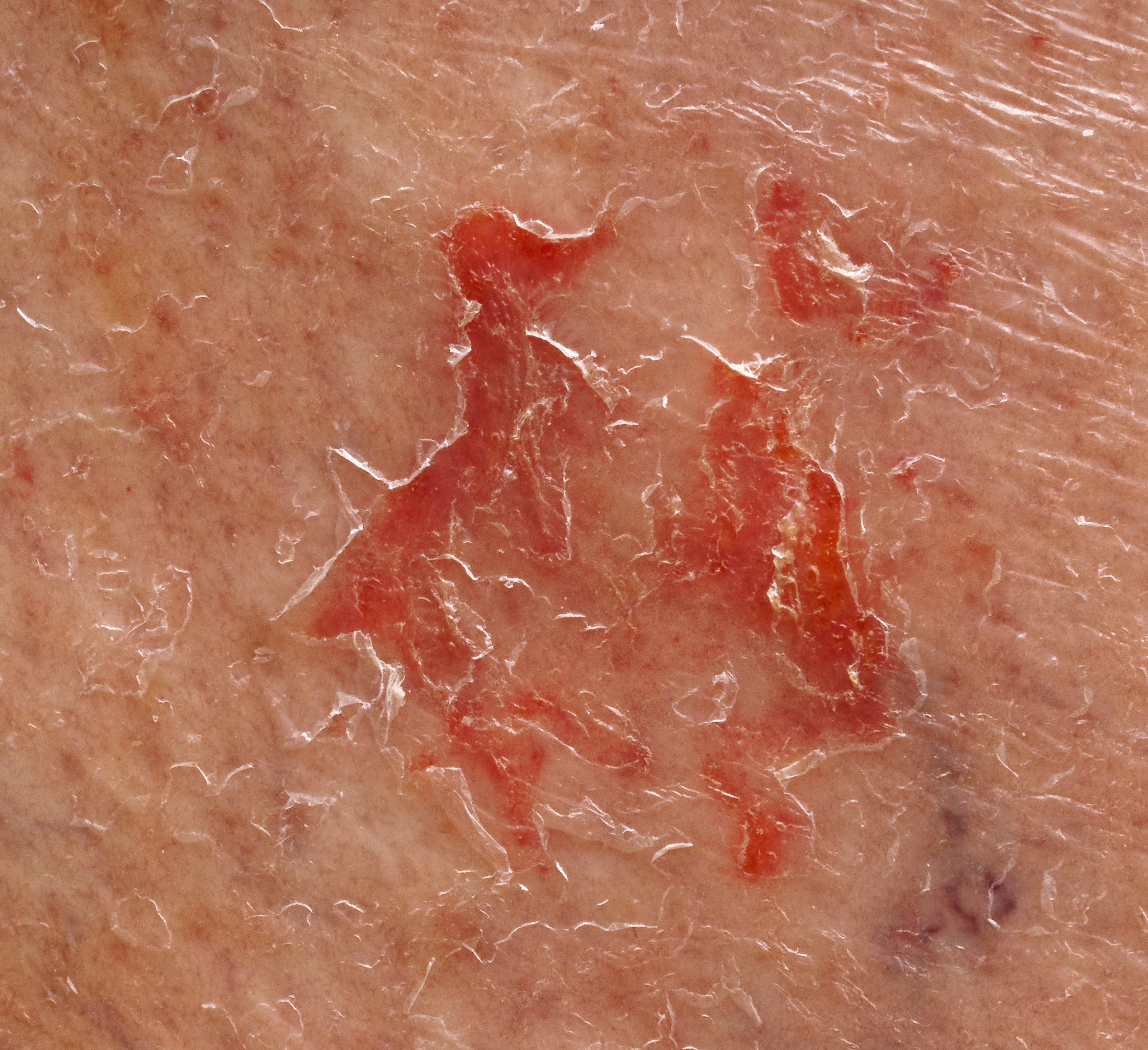https://lemis.nyc3.digitaloceanspaces.com/grog/Photos/20260921/big/Skin-infection-2.jpeg